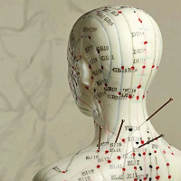 Traditional acupuncture