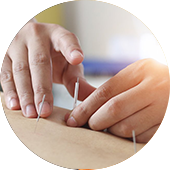 Trigger point acupuncture